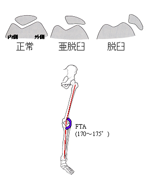 膝蓋骨動揺(脱臼、亜脱臼)