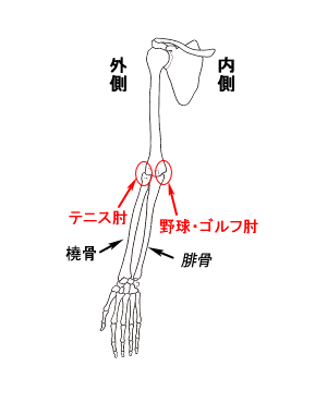 テニス肘