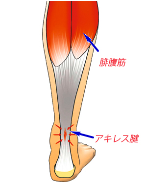 アキレス腱断裂