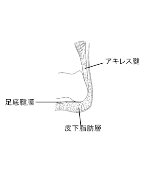 踵骨痛(疼痛性踵パッド)