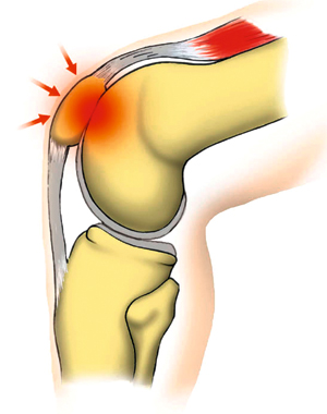 膝蓋大腿部痛症候群